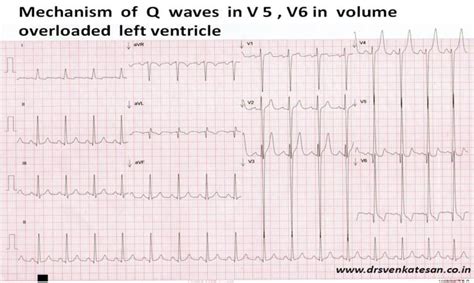 lv volume overload|Lv overload or aspecific change.